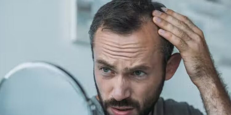 Reasons Of Baldness బట్టతల రావటానికి ఇవే కారణాలు.. వీటిని కనుక దూరం పెట్టారంటే మీరు బట్టతలకు దూరంగా ఉన్నట్టే…