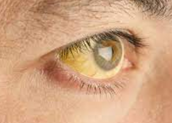 Health కామెర్లు.. తినాల్సిన..  తినకూడని పదార్థాల పూర్తి వివరణ…