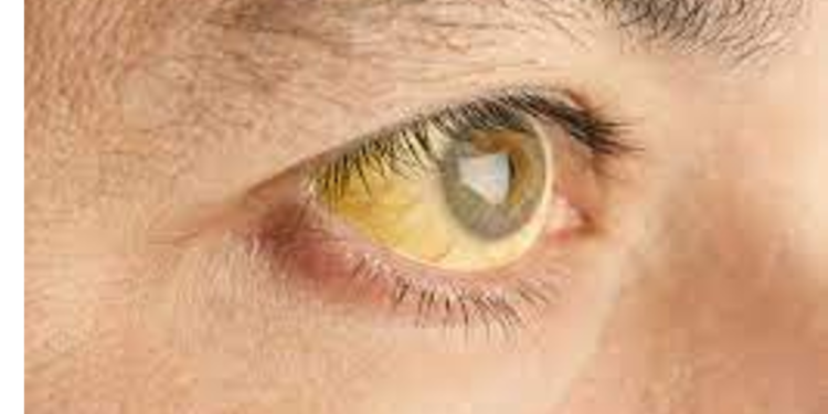 Health కామెర్లు.. తినాల్సిన.. తినకూడని పదార్థాల పూర్తి వివరణ…