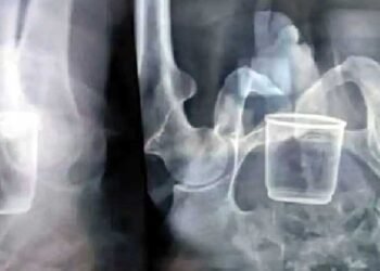 A Old Man Ramdas In Rajgarh district of Madhya Pradesh A Glas In Stomach,Telugu Golden TV,v9 news telugu,,My Mix Entertainments,telugu world news,www.teluguworldnow.com