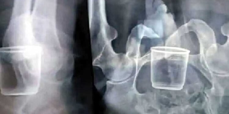 A Old Man Ramdas In Rajgarh district of Madhya Pradesh A Glas In Stomach,Telugu Golden TV,v9 news telugu,,My Mix Entertainments,telugu world news,www.teluguworldnow.com