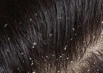 Health : చుండ్రు వేధిస్తుందా.. ఈ చిట్కాలు ఫాలో అవ్వండి..