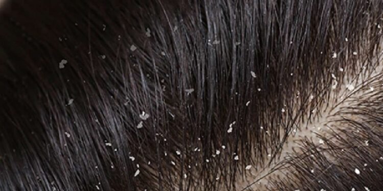 Health : చుండ్రు వేధిస్తుందా.. ఈ చిట్కాలు ఫాలో అవ్వండి..